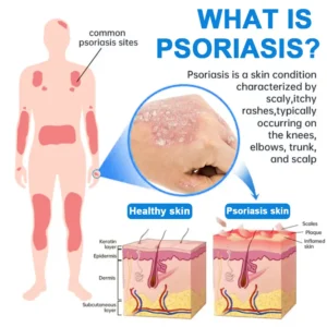 Cvreoz® Magnesium Herbal Psoriasis Spray 👨‍⚕️ FDA Approved