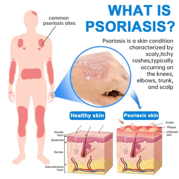 Cvreoz® Magnesium Herbal Psoriasis Spray 👨‍⚕️ FDA Approved