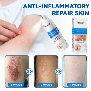 Cvreoz® Magnesium Herbal Psoriasis Spray 👨‍⚕️ FDA Approved