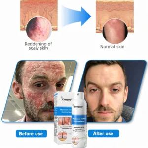 Cvreoz® Magnesium Herbal Psoriasis Spray 👨‍⚕️ FDA Approved