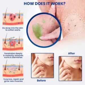 🔥FDA Approved⭐ WHO Approved🌍 Cvreoz® NatureErase Instant Mole & Spot Removal Gel - Deep Penetrated✅ All Natural Ingredients🌿