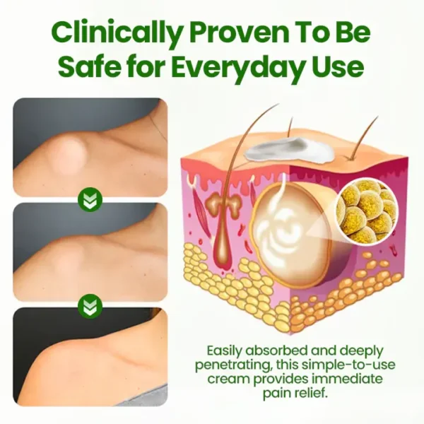 LIMITED TIME SALE OFF 70%🔥 Cvreoz® KnotAway Lipoma Removal Cream