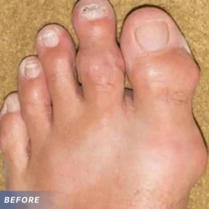 CVREOZ GoutEase Relief Spray