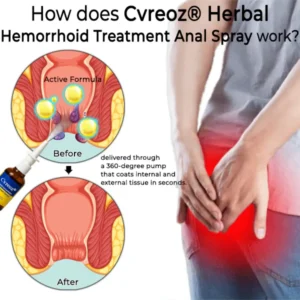Cvreoz® Herbal Hemorrhoid Treatment Anal Spray