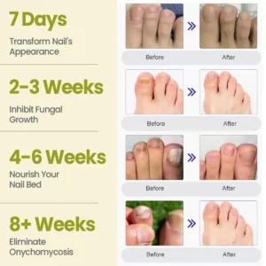 🍃Cvreoz® Nail Fungal Patches Pro+