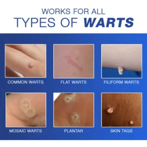 🔥Warts No More - 50% OFF | Cvreoz® Wart Eraser Pro