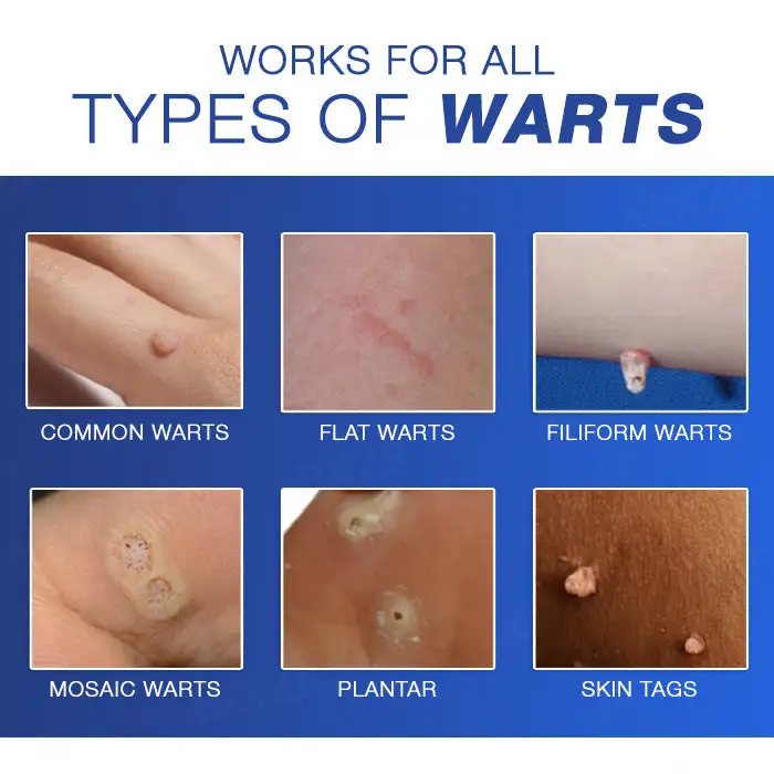 🔥Warts No More - 50% OFF | Cvreoz® Wart Eraser Pro