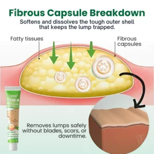 🏷️ EXCLUSIVE DEAL! 50% OFF - Cvreoz® Knot-X Lipoma Dissolve Cream